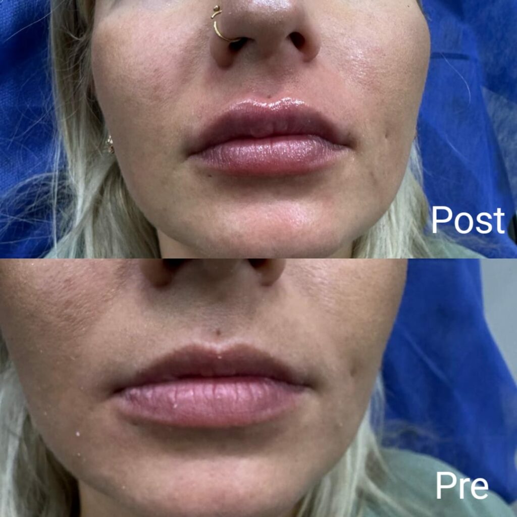 تكبير الشفايف بالفيلر